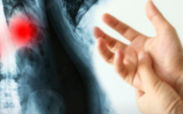 Doctors reveal signs on the fingers that indicate a risk of 'lung cancer'