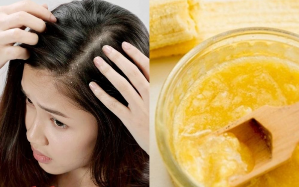 Effective Home Remedy for Dandruff Using Ripe Bananas