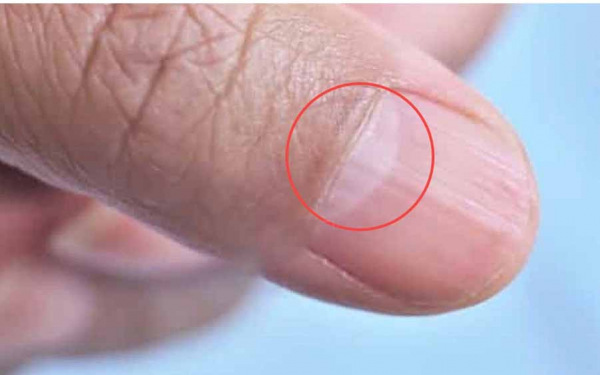 If you see a white crescent-shaped mark on your finger, go see a doctor immediately