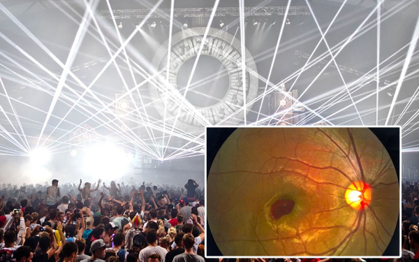 Stage Laser Lights: A Two-Second Danger That Could Cause Permanent Eye Damage